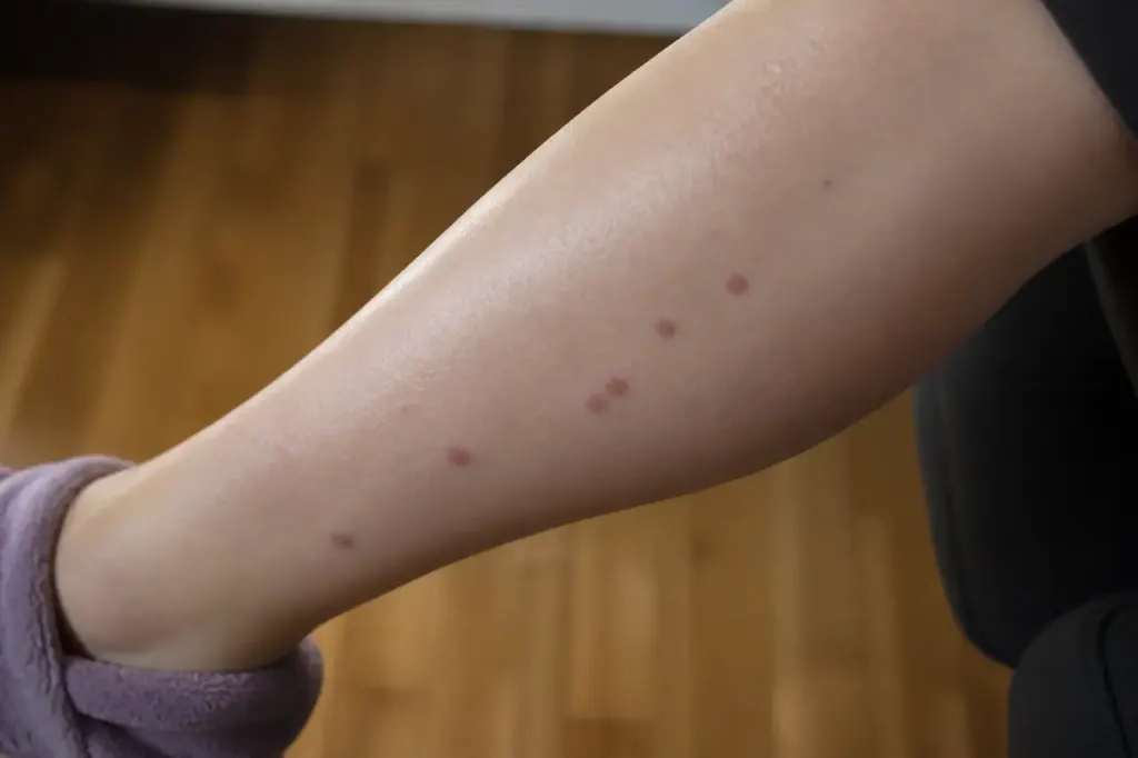 Boutons rouges alignes sur la peau d'une jambe