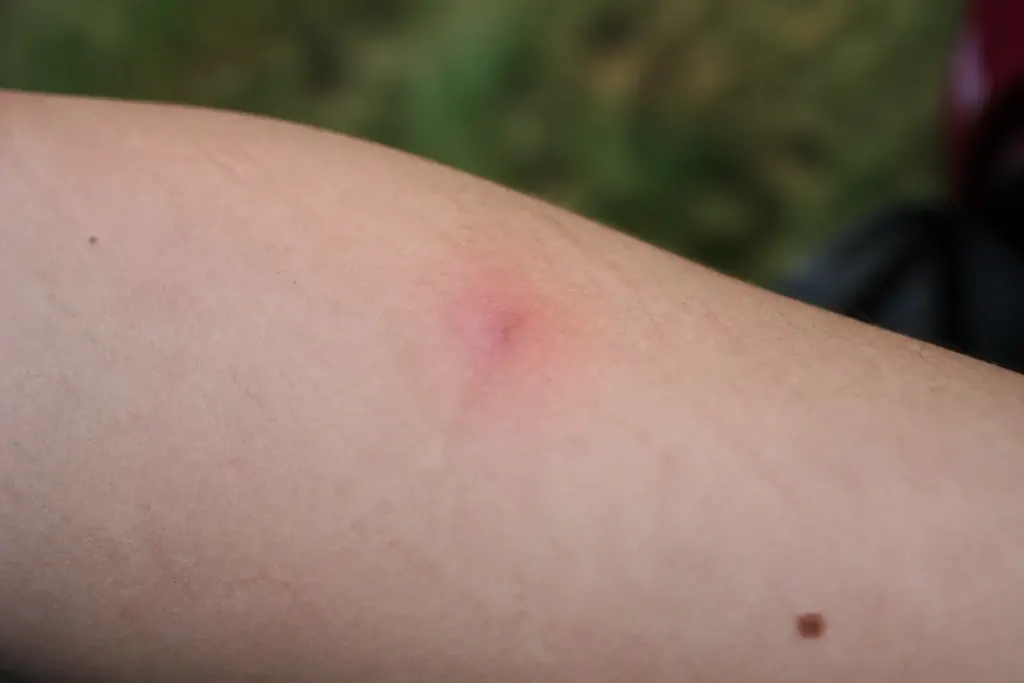 Peau avec legere rougeur apres morsure tique