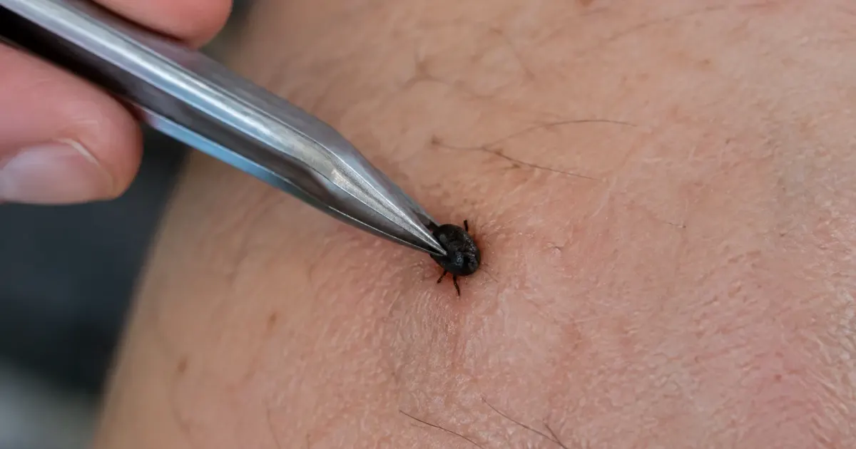 Pince extrayant parasite noir enfonce dans peau